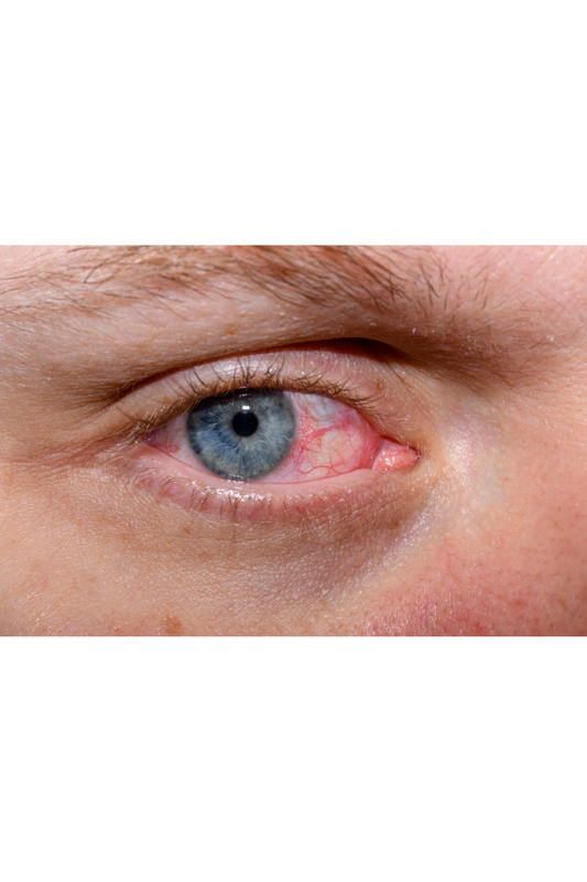 Understanding the Spectrum: Exploring the 6 Types of Dry Eye